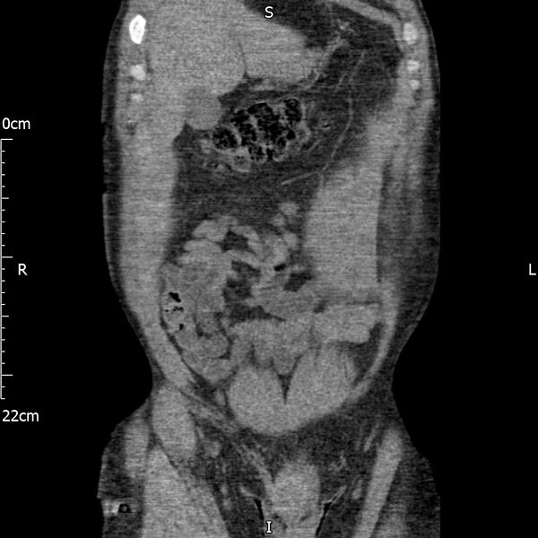 File:Bilateral medullary nephrocalcinosis with ureteric calculi (Radiopaedia 71269-81569 Coronal non-contrast 14).jpg