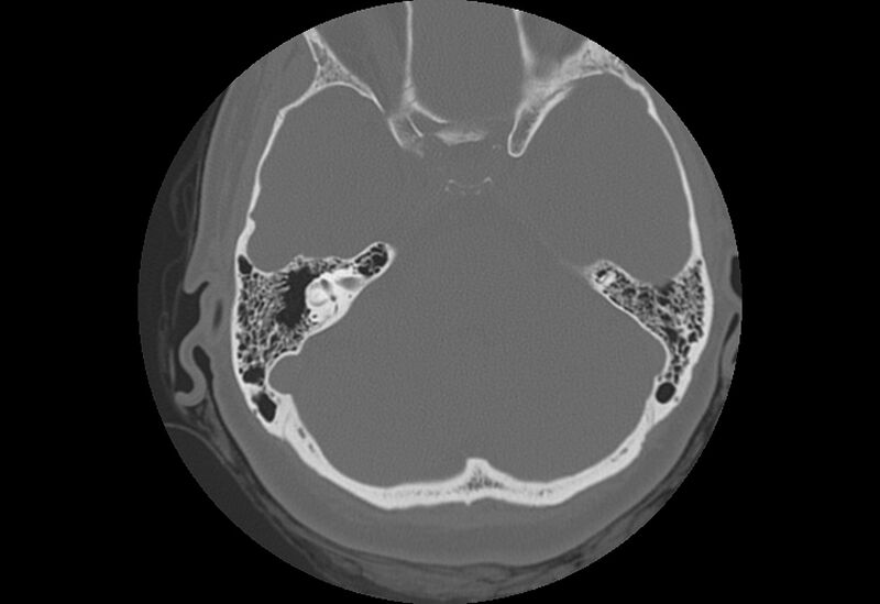 File:Bilateral otospongiosis (Radiopaedia 35447-36940 Axial bone window 39).jpg