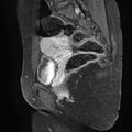 Bilateral ovarian endometriomas (Radiopaedia 87085-103347 F 10).jpg