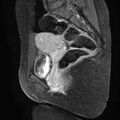 Bilateral ovarian endometriomas (Radiopaedia 87085-103347 F 11).jpg