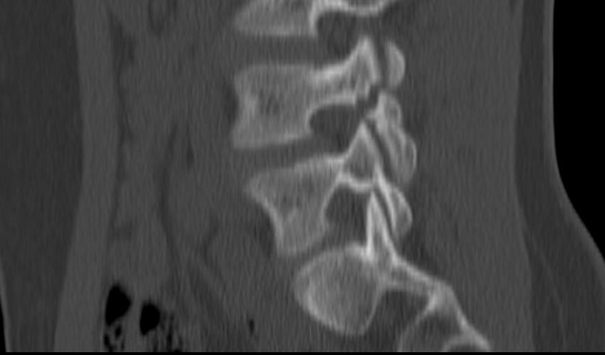 Bilateral pars defect (Radiopaedia 26691-26846 Sagittal bone window 23).jpg
