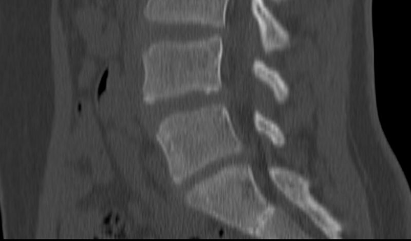 File:Bilateral pars defect (Radiopaedia 26691-26846 Sagittal bone window 28).jpg
