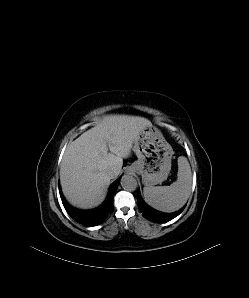 File:Bilateral sporadic synchronous clear cell renal cell carcinoma (Radiopaedia 85035-100572 Axial non-contrast 9).jpg