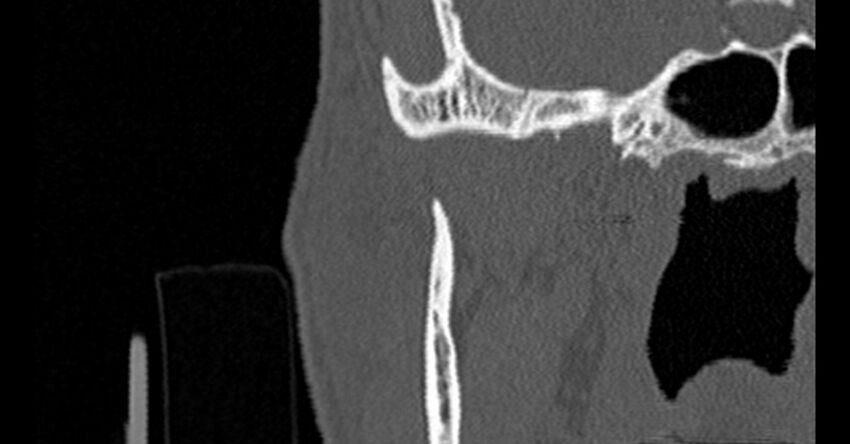 Bilateral temporal bone fractures (Radiopaedia 29482-29970 Coronal non-contrast 8).jpg