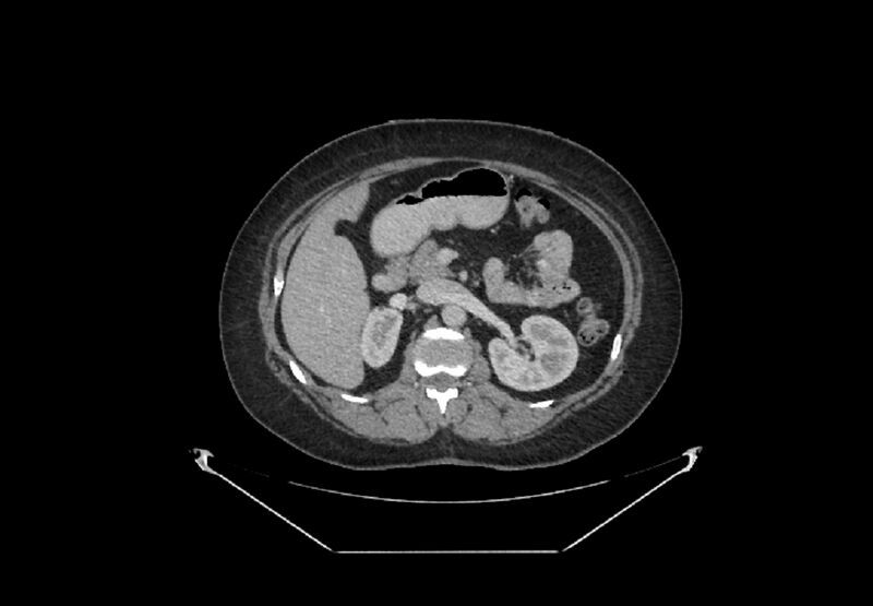 File:Bilateral urolithiasis with incidentally detected splenic artery aneurysm and left inferior vena cava (Radiopaedia 44467-48127 B 31).jpg