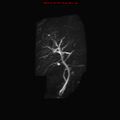 Biliary tree anatomical variant - biliary trifurcation (Radiopaedia 12531-12750 Coronal 3D MRCP 19).jpg