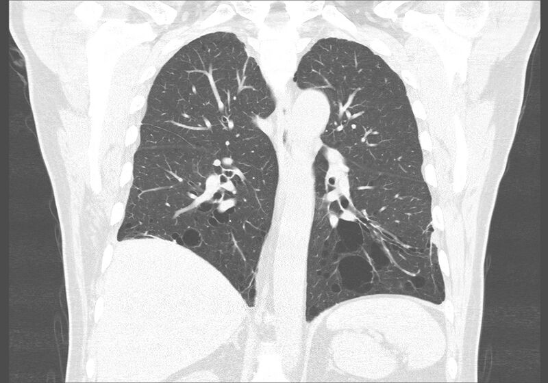 File:Birt-Hogg-Dubé syndrome (Radiopaedia 52578-58491 Coronal lung window 38).jpg