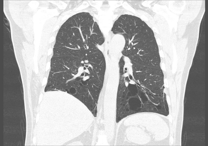 Birt-Hogg-Dubé syndrome (Radiopaedia 52578-58491 Coronal lung window 38).jpg
