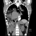 Bochdalek diaphragmatic hernia (Radiopaedia 38866-41059 Coronal liver window 13).jpg