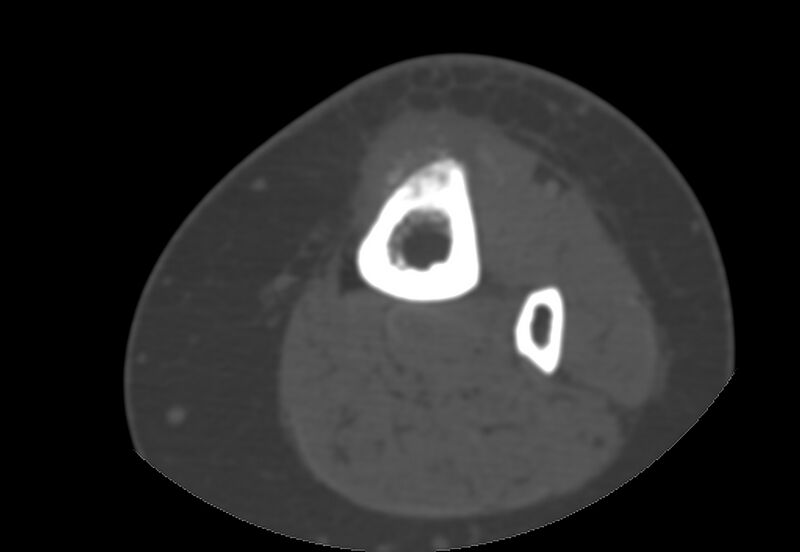 File:Bone metastasis - tibia (Radiopaedia 57665-64609 Axial bone window 35).jpg