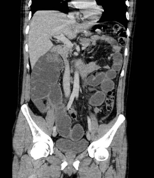 File:Bowel obstruction from colon carcinoma (Radiopaedia 22995-23028 C 35).jpg