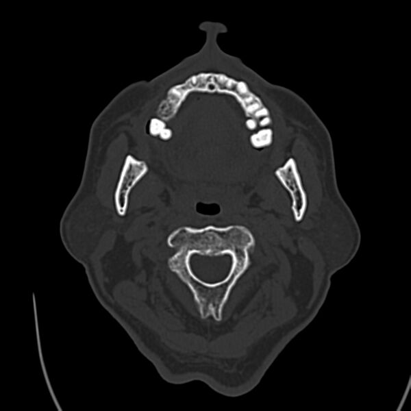 File:Brain Pantopaque remnants (Radiopaedia 78403-91048 Axial bone window 2).jpg