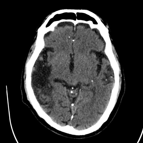 File:Brain Pantopaque remnants (Radiopaedia 78403-91048 Axial non-contrast 46).jpg
