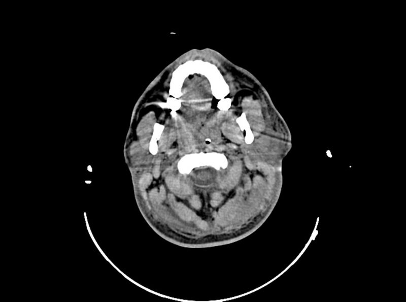 File:Brain injury by firearm projectile (Radiopaedia 82068-96087 B 22).jpg