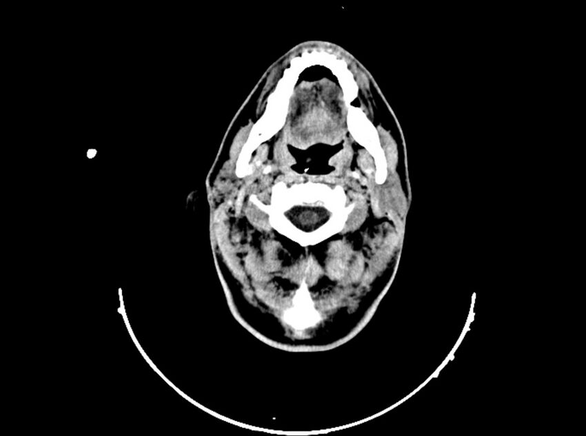 Brain injury by firearm projectile (Radiopaedia 82068-96088 A 50).jpg