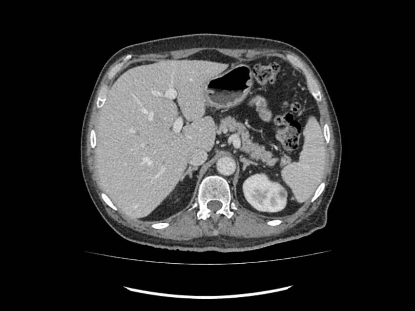 Brain metastases from renal cell carcinoma (Radiopaedia 42222-45328 B 20).jpg