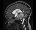 Brainstem glioma (Radiopaedia 21819-21775 Sagittal T2 13).jpg