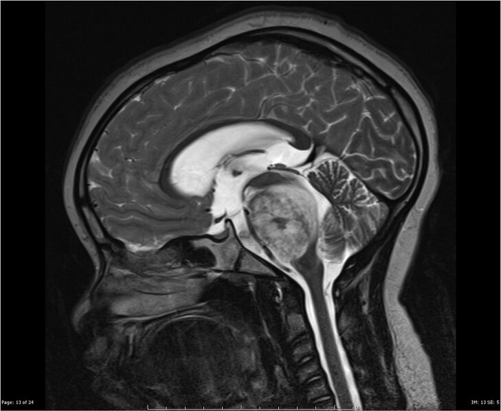 File:Brainstem glioma (Radiopaedia 21819-21775 Sagittal T2 13).jpg