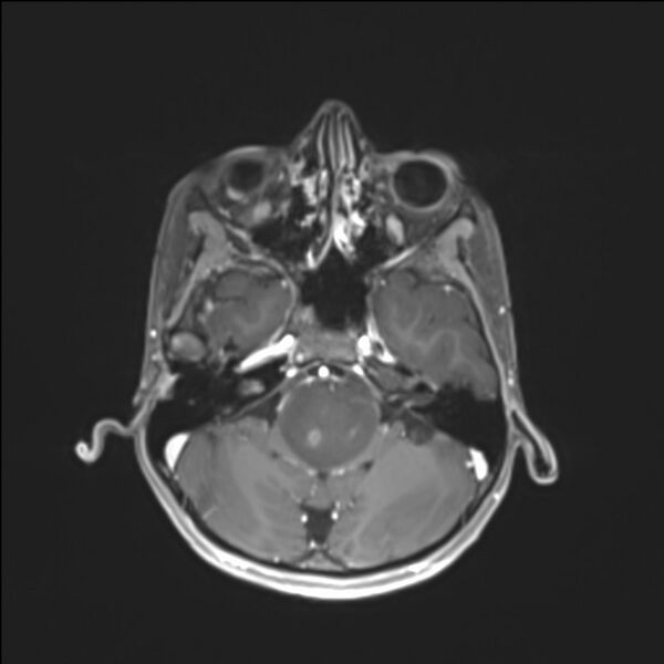 File:Brainstem glioma (Radiopaedia 70548-80674 Axial T1 C+ 41).jpg