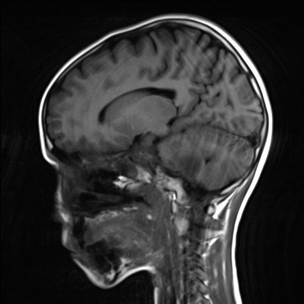 File:Brainstem glioma (Radiopaedia 70548-80674 Sagittal T1 9).jpg