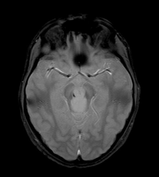 File:Brainstem glioma - focal midbrain (Radiopaedia 6525-7840 Axial Gradient Echo 1).jpg
