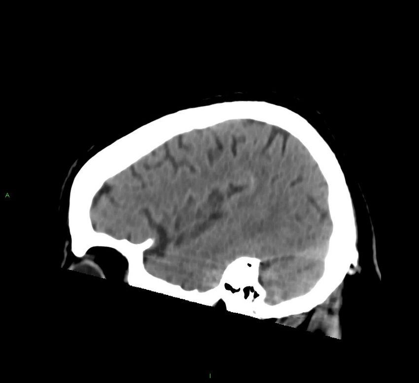 Brainstem hemorrhage (Radiopaedia 58794-66028 C 12).jpg
