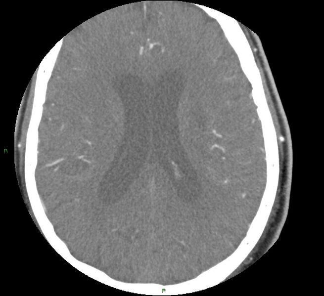 File:Brainstem hemorrhage (Radiopaedia 58794-66028 D 117).jpg