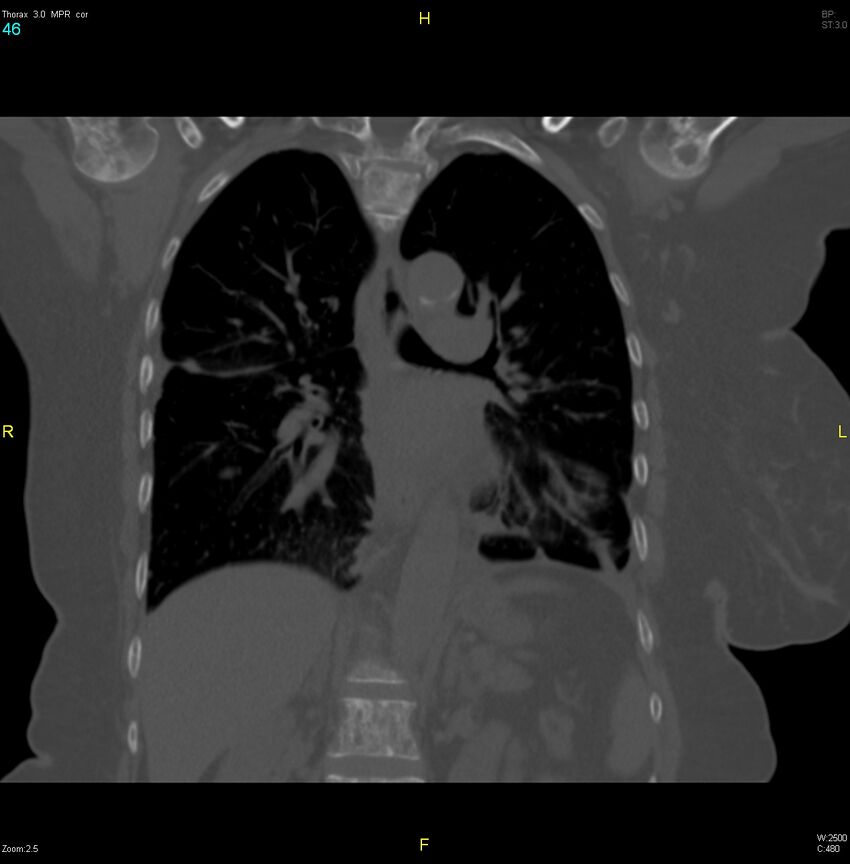 Breast primary with lung and bone metastases (Radiopaedia 40620-43228 bone window 46).jpg