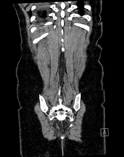 File:Broad ligament hernia (Radiopaedia 84802-100276 B 1).jpg