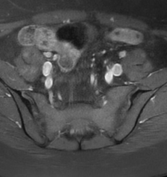 File:Broad ligament leiomyoma (Radiopaedia 81634-95516 Axial T1 C+ fat sat 4).jpg