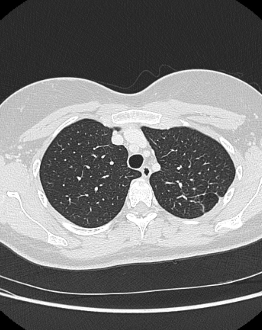 Bronchial atresia (Radiopaedia 50007-55297 Axial lung window 21).jpg