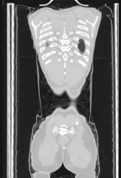 File:Bronchial carcinoid tumor (Radiopaedia 57187-64090 Coronal lung window 105).jpg