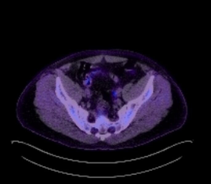 File:Bronchial carcinoid tumor (Radiopaedia 67377-76766 18FDG-PET-CT 55).jpg