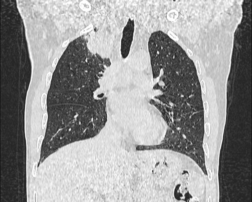 Bronchogenic carcinoma with superior vena cava syndrome (Radiopaedia 36497-38054 Coronal lung window 30).jpg