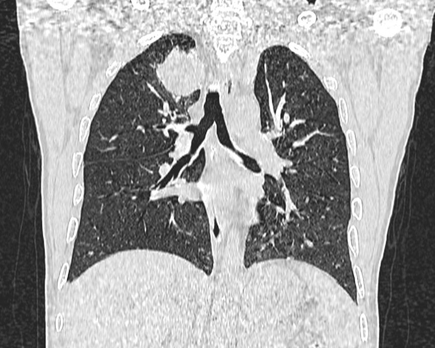 Bronchogenic carcinoma with superior vena cava syndrome (Radiopaedia 36497-38054 Coronal lung window 52).jpg