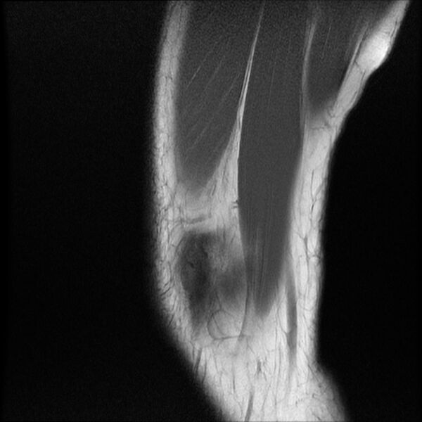 File:Bucket-handle meniscus tear (Radiopaedia 65700-74809 Sagittal T1 3).jpg