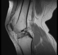 Bucket handle tear - medial meniscus (Radiopaedia 24900-25163 Sagittal T2 8).png