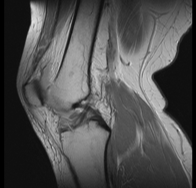 File:Bucket handle tear - medial meniscus (Radiopaedia 24900-25163 Sagittal T2 8).png