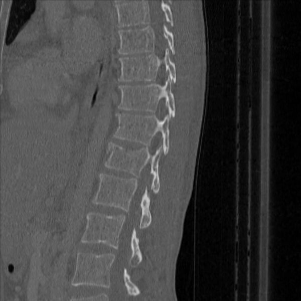 File:Bulging of paraspinal line in traumatic thoracal spinal compression fracture (Radiopaedia 29221-35872 Sagittal bone window 33).jpg