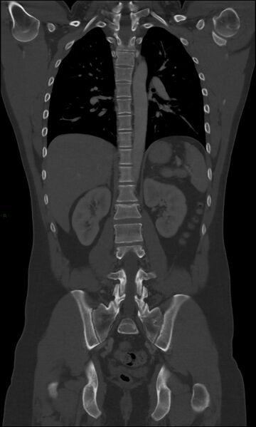 File:Burst fracture (Radiopaedia 83168-97542 Coronal bone window 47).jpg