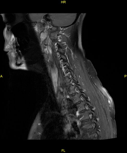 File:C5 nerve sheath tumor (Radiopaedia 85777-101596 F 7).jpg