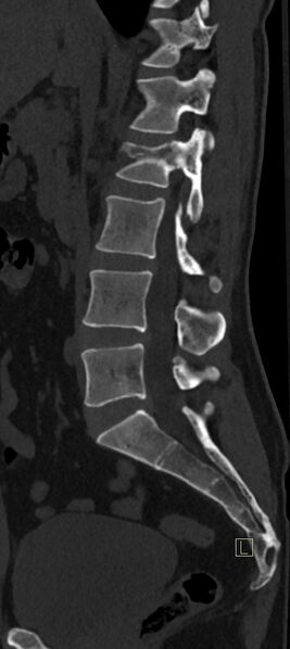 File:Calcaneal fractures with associated L2 burst fracture (Radiopaedia 71671-82493 Sagittal bone window 43).jpg