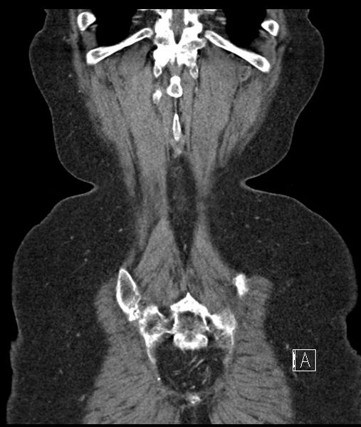 File:Calcified adrenal glands and Spigelian hernia (Radiopaedia 49741-54988 B 108).jpg