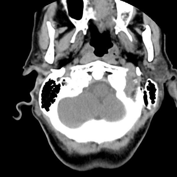 File:Calcified meningioma - cervical canal (Radiopaedia 70136-80171 B 2).jpg