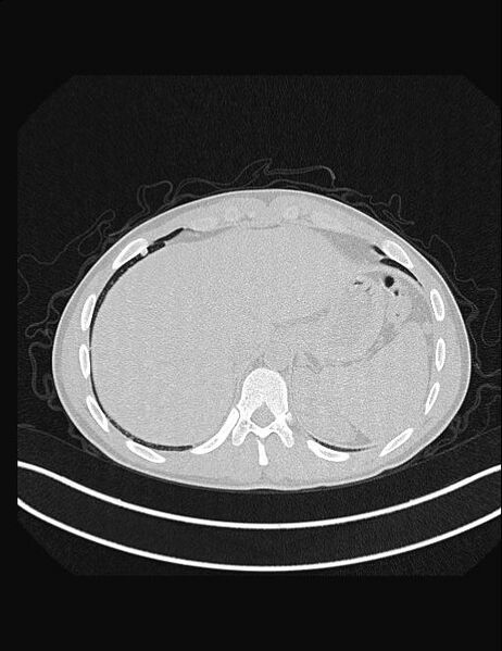 File:Calcifying pulmonary metastases (Radiopaedia 33359-34396 Axial lung window 57).jpg