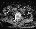Cancer cervix - stage IIb (Radiopaedia 75411-86615 Axial ADC 7).jpg
