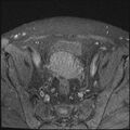 Cancer cervix - stage IIb (Radiopaedia 75411-86615 T1 fat sat 21).jpg