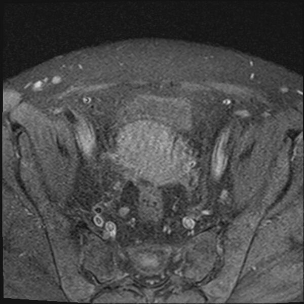 File:Cancer cervix - stage IIb (Radiopaedia 75411-86615 T1 fat sat 21).jpg
