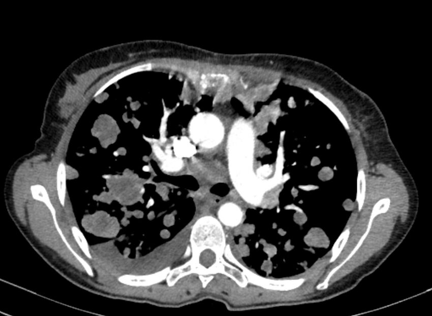 Cannonball metastases from breast cancer (Radiopaedia 91024-108569 A 50).jpg