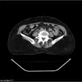 Carcinoma cervix- recurrence (Radiopaedia 34702-36137 B 34).jpg